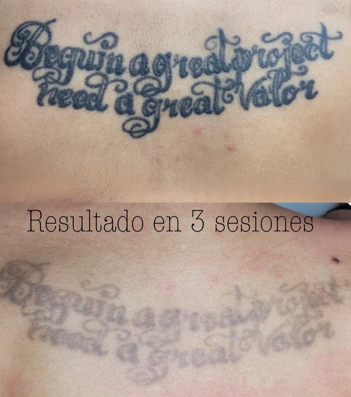 Eliminación de tatuaje con láser antes y después — Isabel Santamaría Sabadell